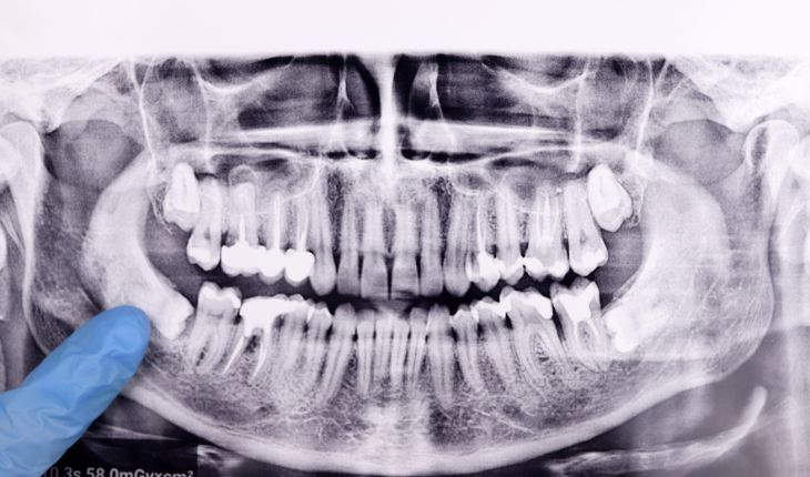 Understanding Wisdom Teeth: Causes, Pain & Treatment