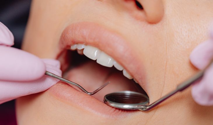 Dental Scaling and Polishing