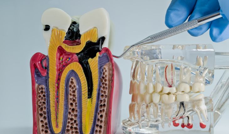 Root Canal or Extraction: Which Procedure Is Right for You?