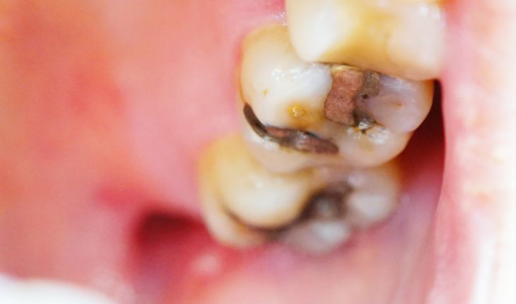 15 Common Dental Problems and How to Prevent Them