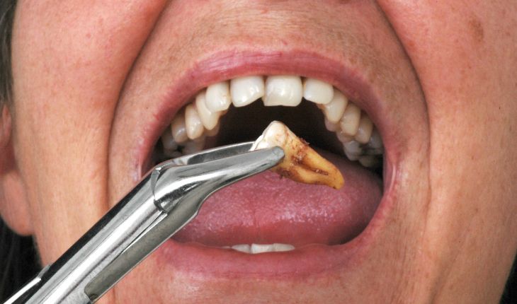 Tooth Extraction Healing: Timeline, Recovery Tips & What to Expect